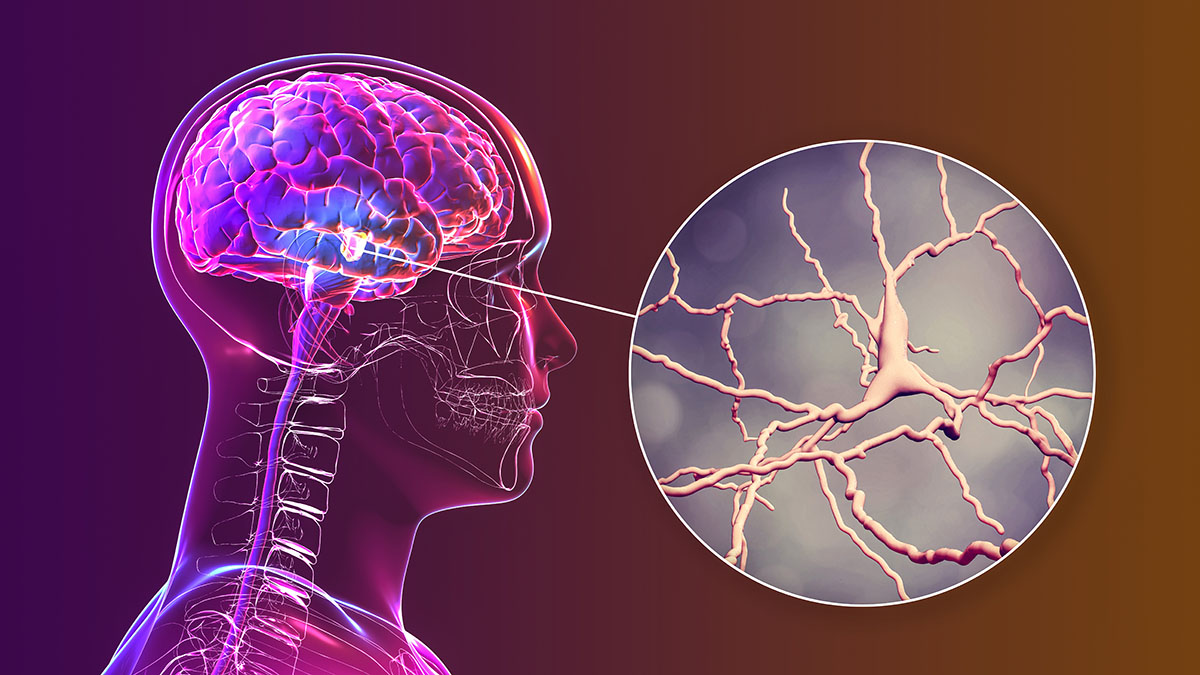 10 warning signs of Parkinson's disease you need to know about